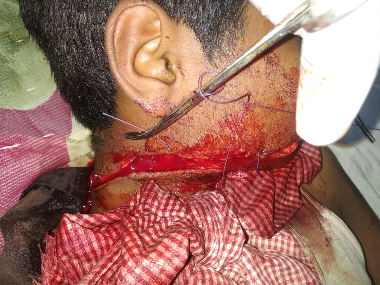 13 वर्षीय बालक मोटरसाइकिल सीखने समय खेत में लगे तारों में कटकर गंभीर घायल