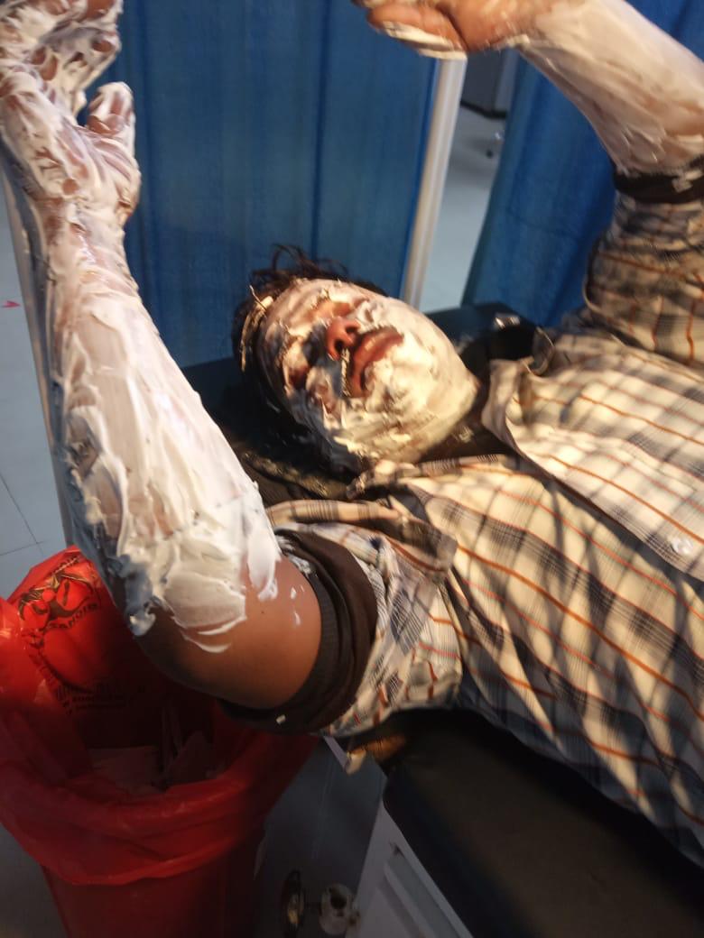 लखनऊ गोमती नगर में दबंगों का हौसले बुलंद होटल के अंदर बाप और बेटे पर फेंका खौलता हुआ तेल